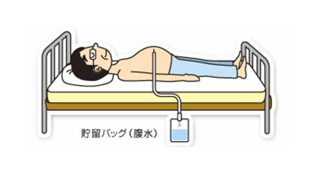 腹水・胸水を抜く